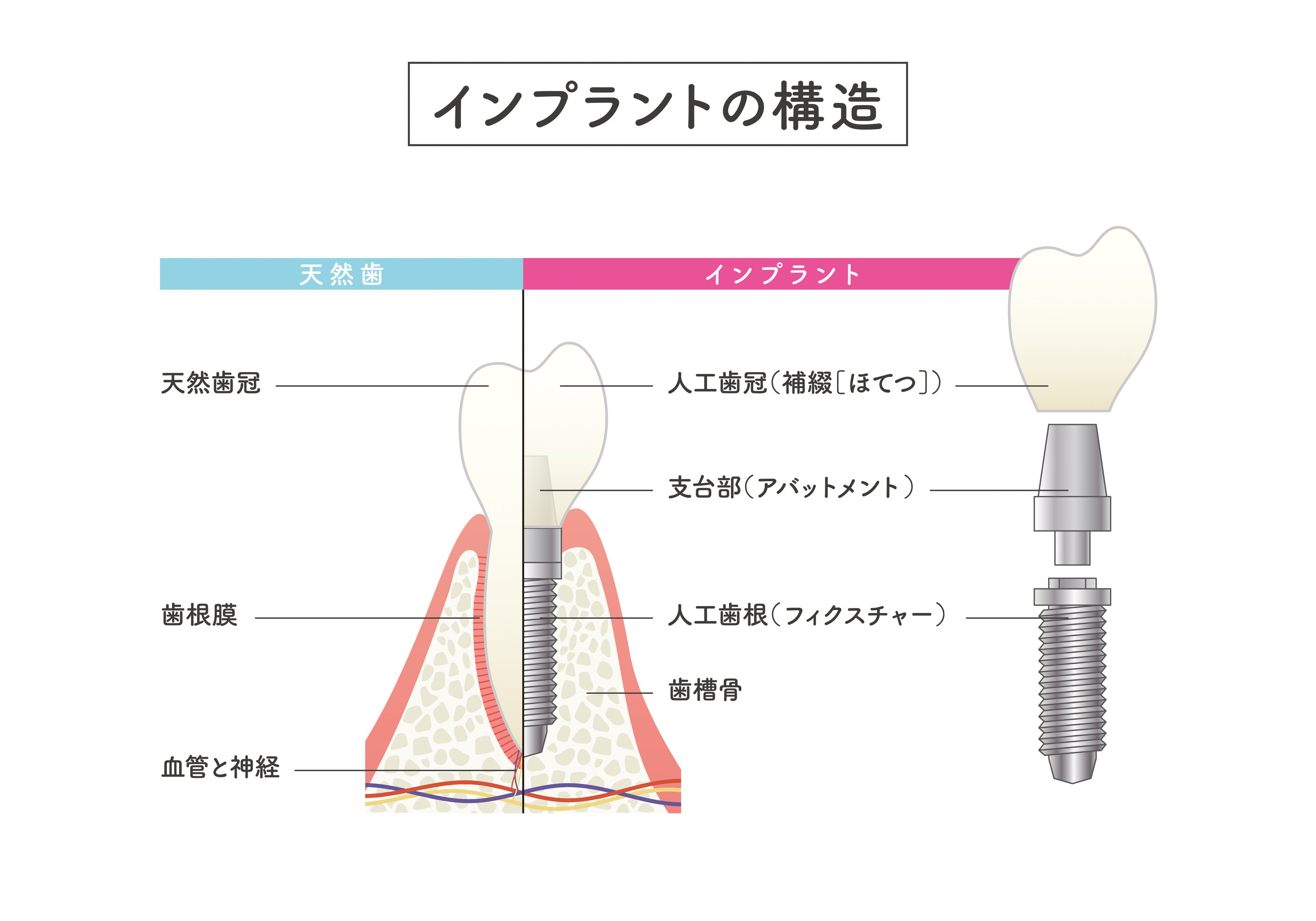 インプラント